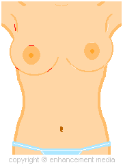 Breast Reduction Liposuction Technique Diagram